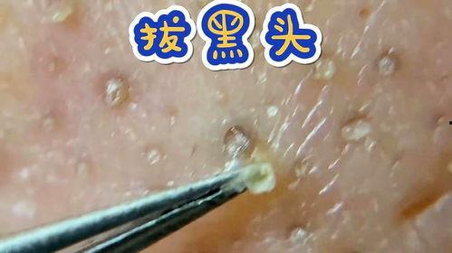 巨大黑头去除视频,高效黑头去除视频解析